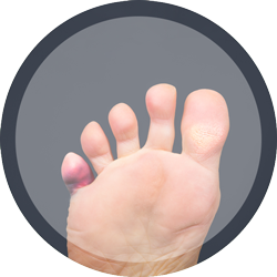 What is a Hammertoe?