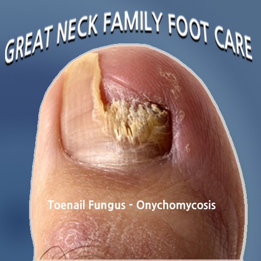 What Causes Toenail Fungus? - Keep Your Feet in the Sand!