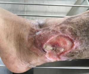 Ulcer From Venous Insufficiency