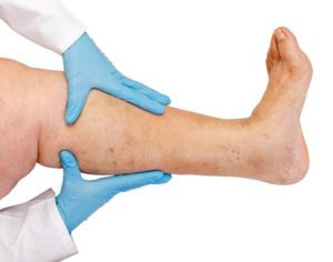 venous-insufficiency