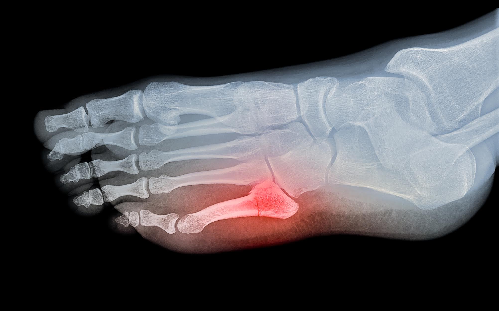 stress fracture in foot healing time
