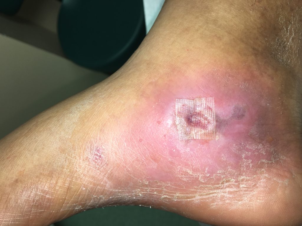wound care for your foot in Nassau County