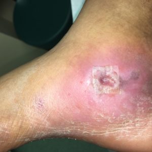 wound care for your foot in Nassau County