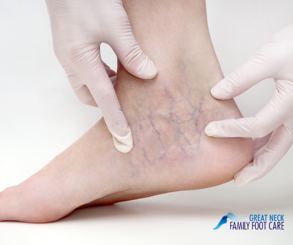 Spider Veins/Telangiectasia - How can we treat this condition? - Great Neck  Family Foot Care