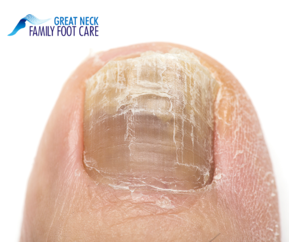 Foot Clinic - Thick Nails