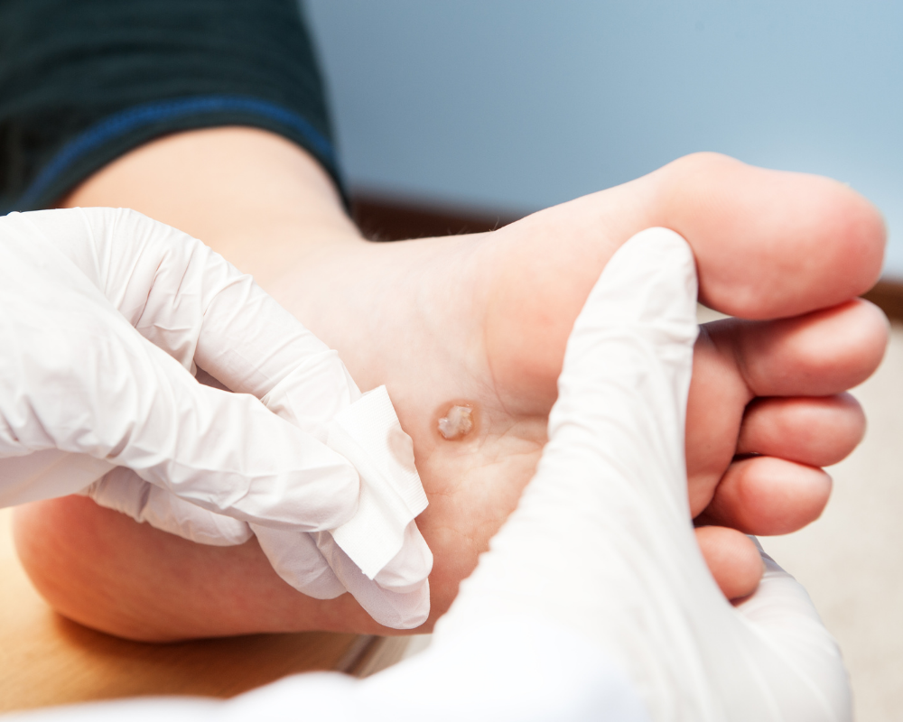 Swift Treatment for Warts